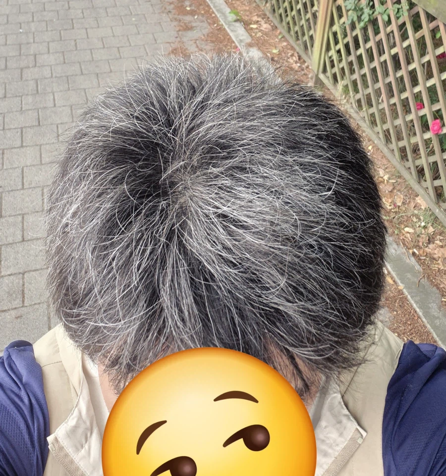 흰머리가 암세포를 방어한 흔적?_5.webp