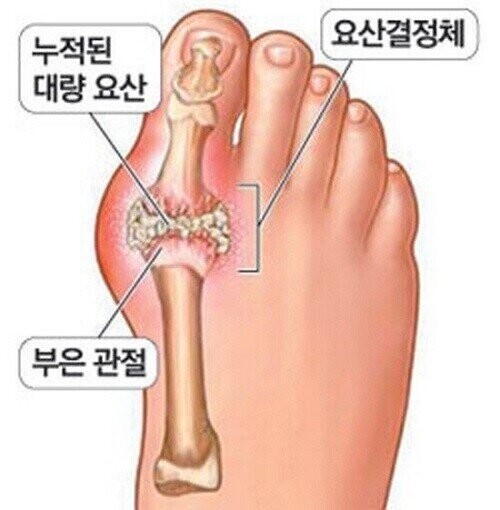 요즘 2030 남성들이 은근 많이 걸리는 질병_1.jpg