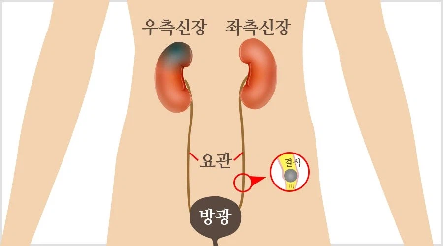 (요로결석) 의외로 사람들 90%가 잘못 알고 있는 정보.JPG_2.webp