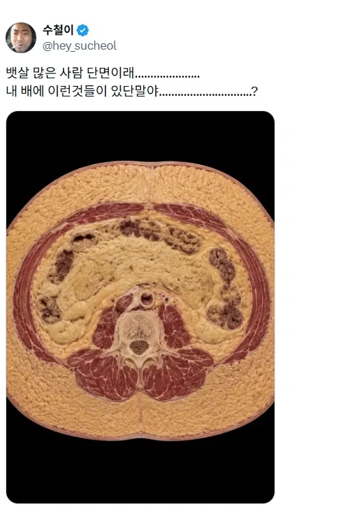 뱃살 많은 사람 단면.jpg_1.webp